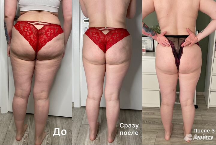 Антицеллюлитный массаж