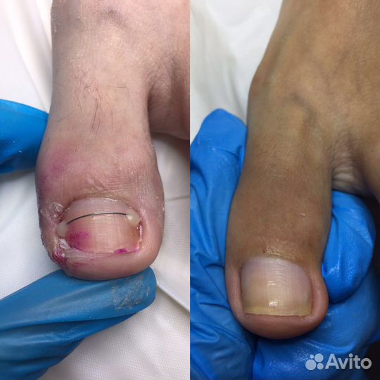 Педикюр/подология/ выезд на дом