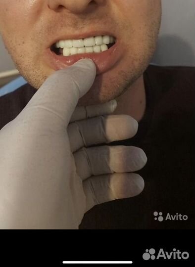 Зубные протезы