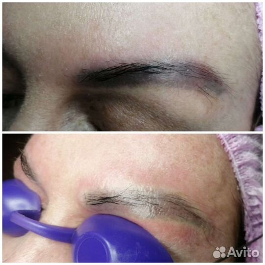 Удаление татуажа лазером/ эпиляция