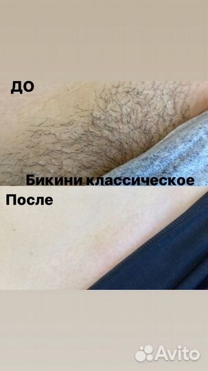 Шугаринг Зеленоград