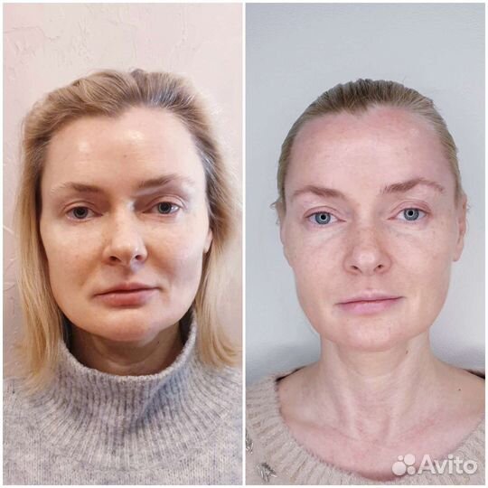 Скульптурный массаж лица