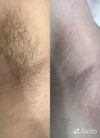 SPA-Шугаринг