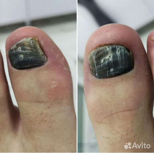 Медицинский педикюр подолог Медиц.Образ