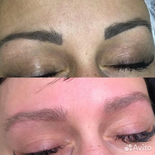 Удаление татуажа бровей, губ, татуировок