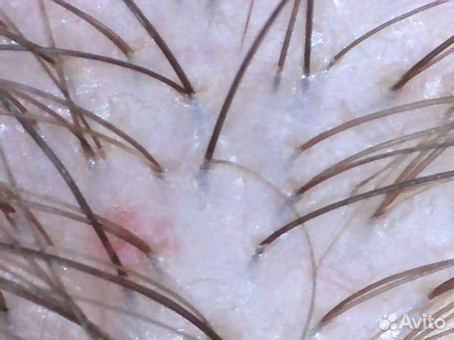 Консультация трихолога-эстетиста