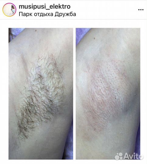 Электроэпиляция