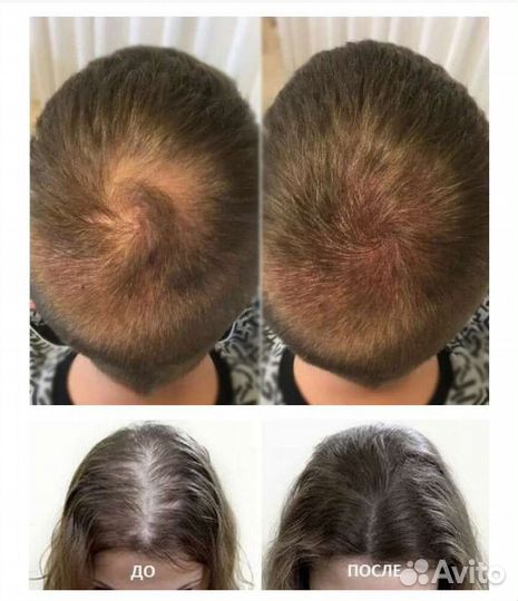 Трихопигментация головы коррекция облысения. Курсы