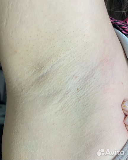 Лазерная эпиляция