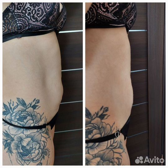 Смас лифтинг тела