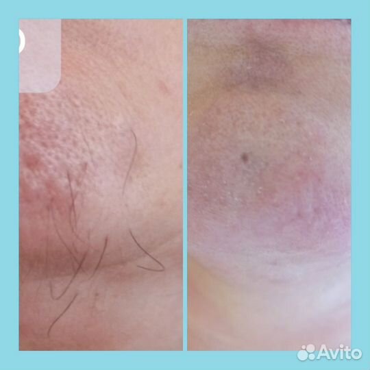 Электроэпиляция