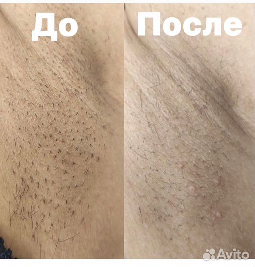 Лазерная эпиляция Элос