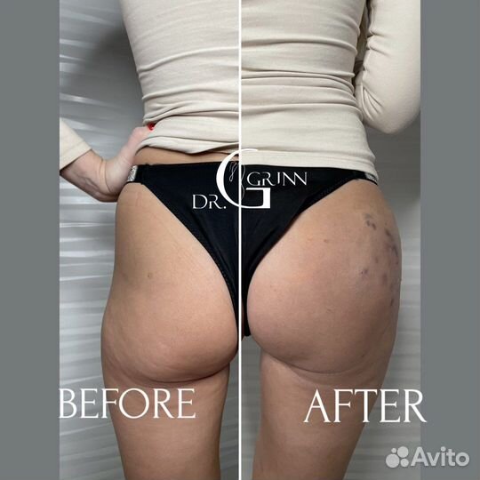 Увеличение ягодиц/груди