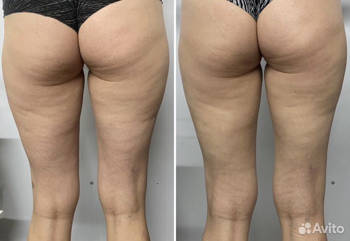 Аппаратная коррекция фигуры