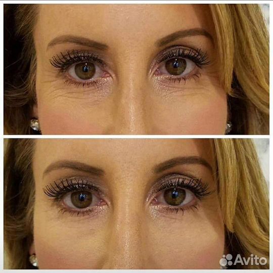 Ботокс/ Ботулинотерапия