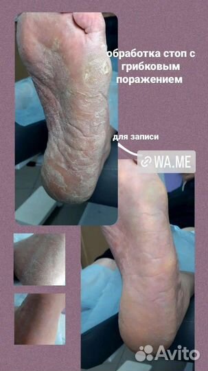 Педикюр / подолог