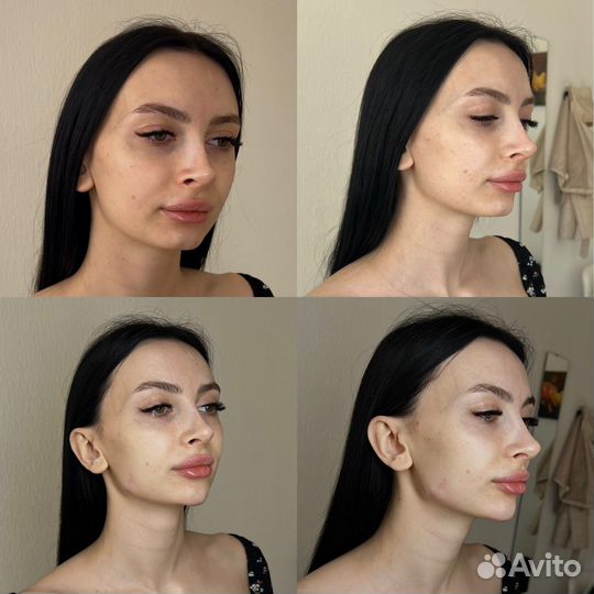 Требуются модели. Контурная пластика лица. Губы