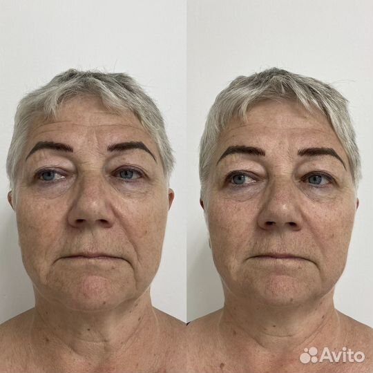 Лифтинг массаж лица