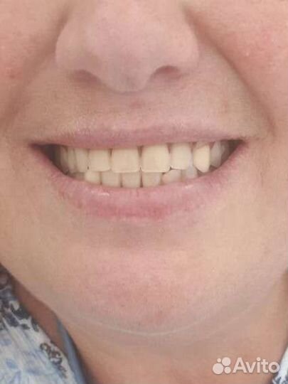 Съемные и несъмные зубные протезы,коронки,ремонт