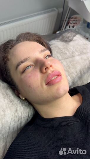 Увеличение губ,биоревитализация,мезотерапия