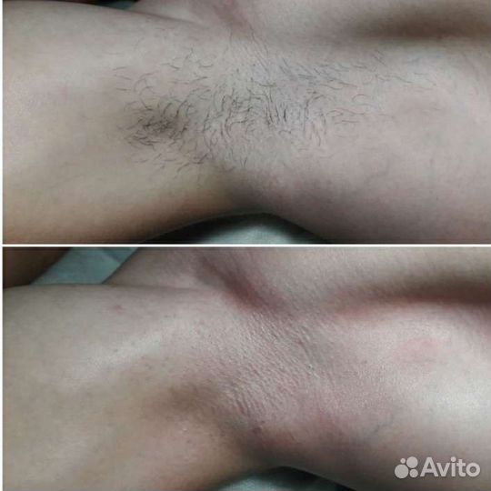 Шугаринг,депиляция воском для женщин и мужчин