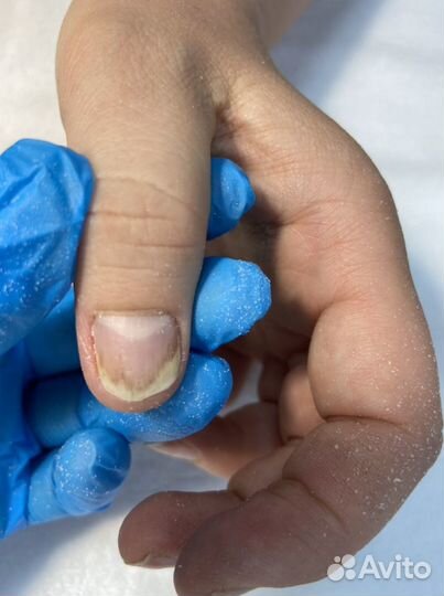 Медицинский педикюр,онихомикоз,онихолизис