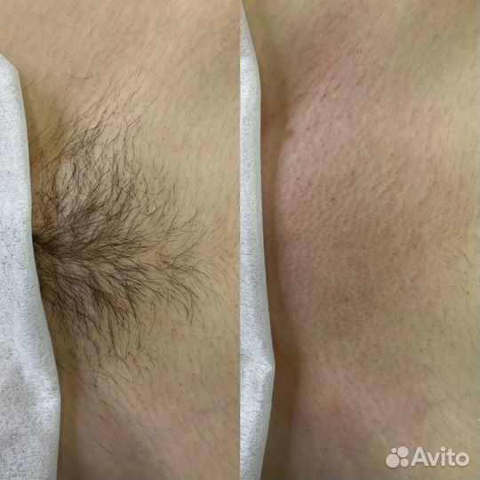 Депиляция женская