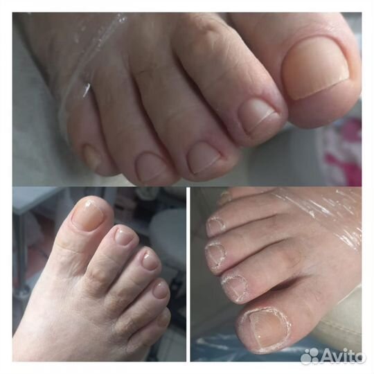 Титановая нить педикюр