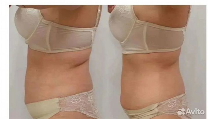 Плоский живот - размер за 1 процедуру Кирове