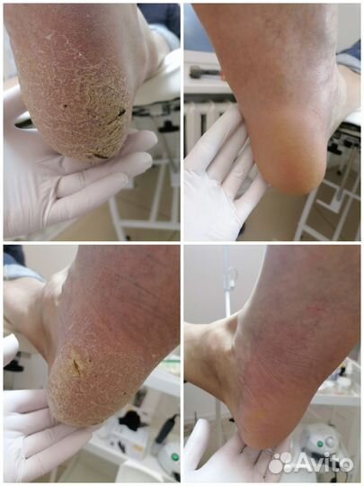 Сертифицированный подолог, лечебный педикюр