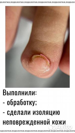 Подолог, вросший ноготь, титановая нить, педикюр