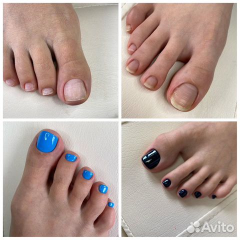 Педикюр подология