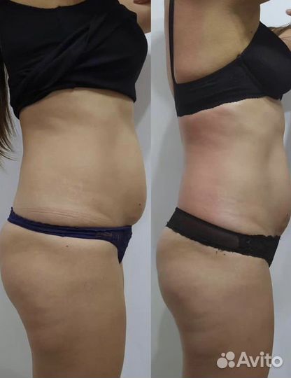 LPG массаж Коррекция фигуры