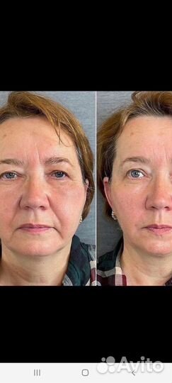 СМАС лифтинг лица