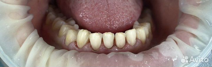 Изготовление эстетических коронок