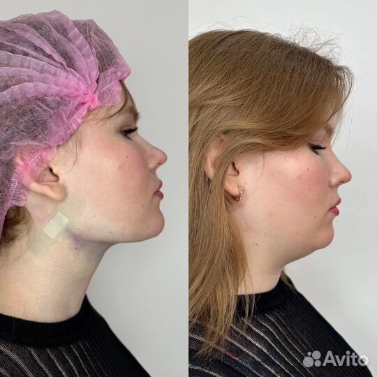 Косметолог Увеличение губ