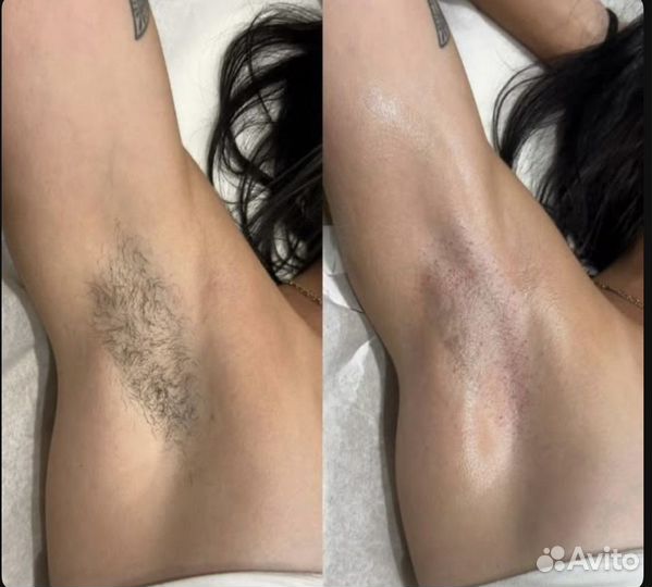 Лазерная эпиляция Диодный Лазер Депиляция