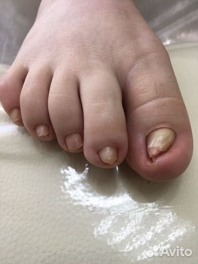 Педикюр с элементами подологии