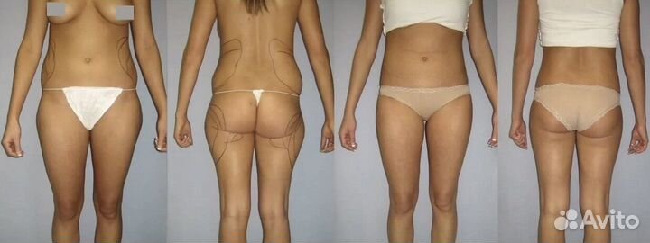 Ультразвуковая Кавитация