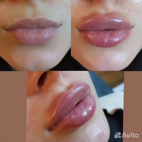 Увеличение губ