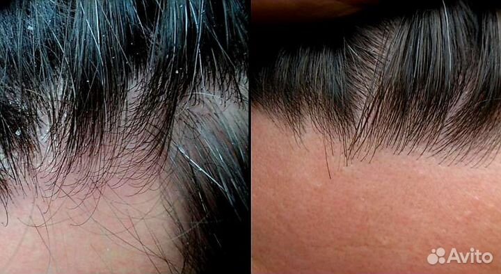 Пилинг кожи головы