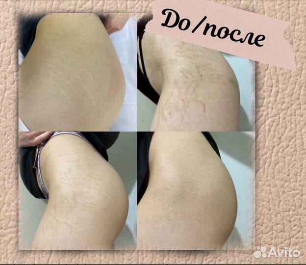 Татуаж растяжек и шрамов