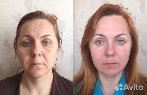 Массаж LPG, кавитация, скульптурный массаж лица