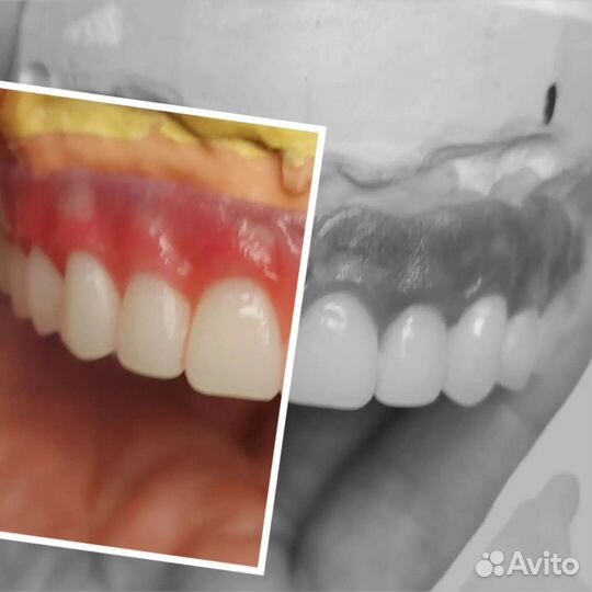 Починки зубных протезов