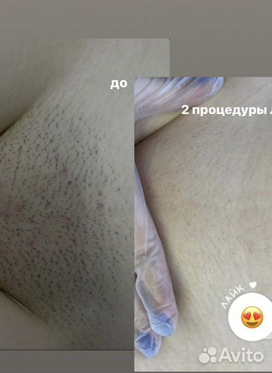 Лазерная эпиляция