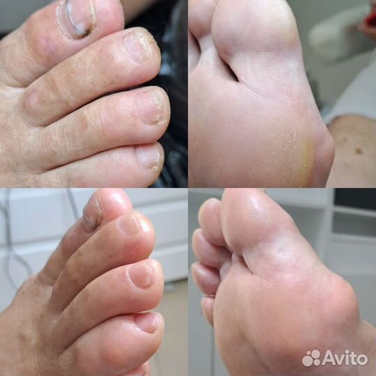 Smart педикюр с элементами подологии, маникюр