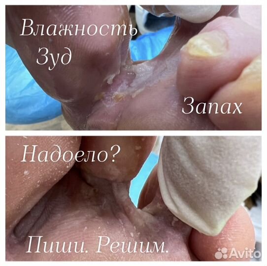 Педикюр сложных стоп