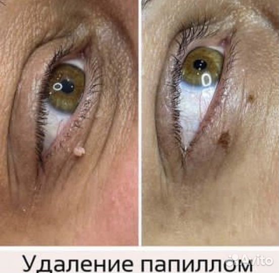 Удаление папиллом