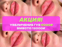 Увеличение губ / Косметолог