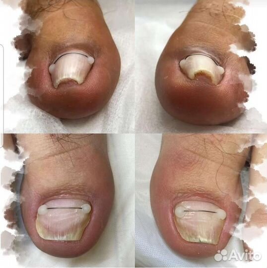 Аппаратный педикюр